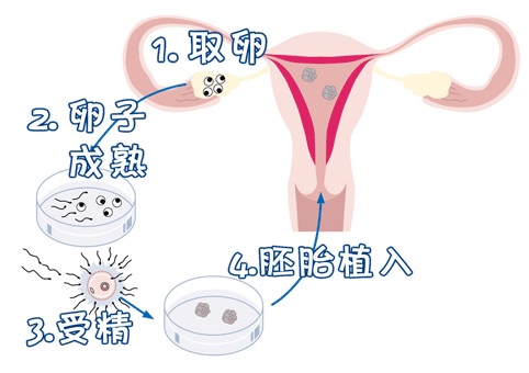 包生男孩助孕机构代生供卵医院试管婴儿中心